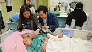 نجاح عملية فصل التوأم الفلبيني كليًا وموريس آن في الرياض