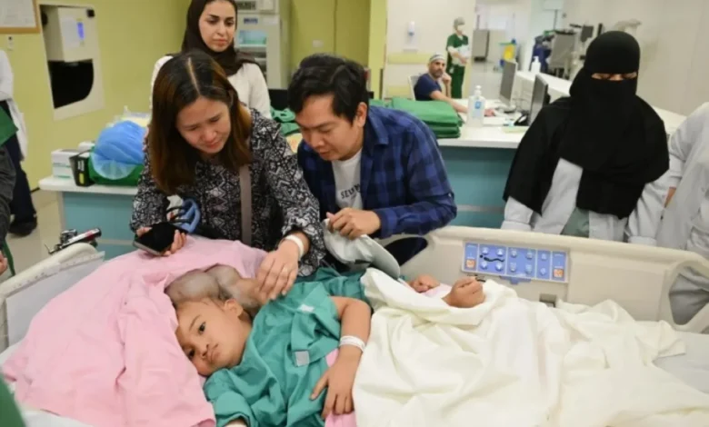 نجاح عملية فصل التوأم الفلبيني كليًا وموريس آن في الرياض